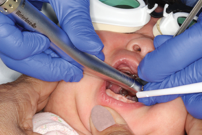 Laser precision treatment